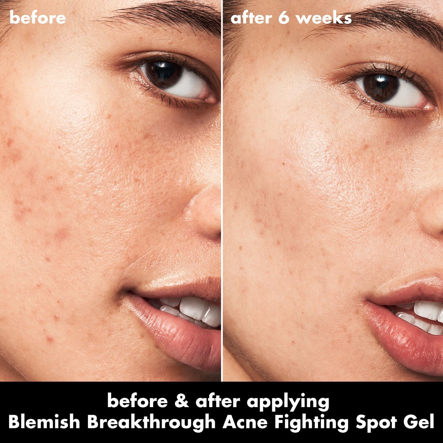 blemish-breakthrough-acne-fighting-spot-gel-j4 0326_EDU_BB_SpotGel_BA_ISABELLA.jpg