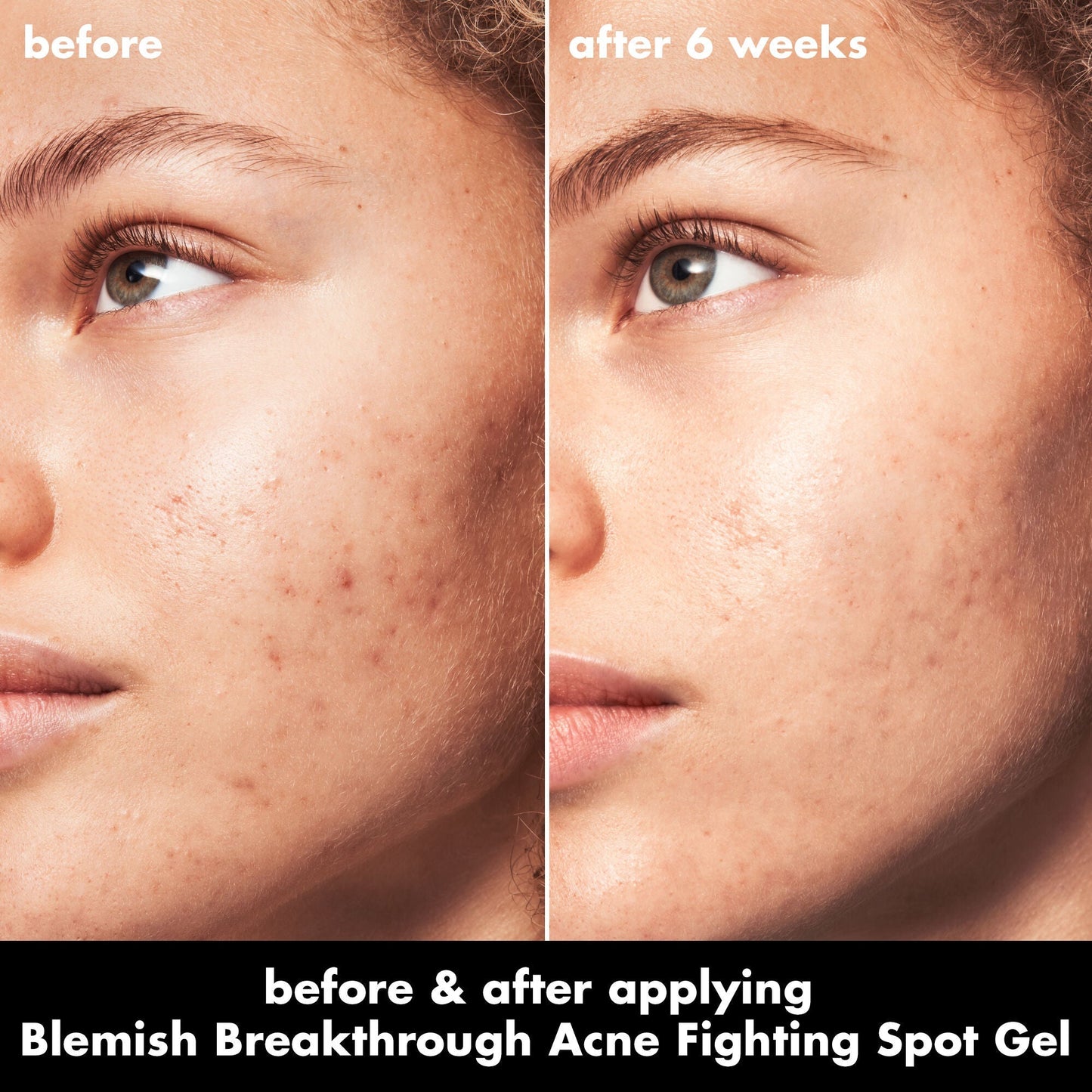 blemish-breakthrough-acne-fighting-spot-gel-j4 0326_EDU_BB_SpotGel_BA_MARLEY.jpg