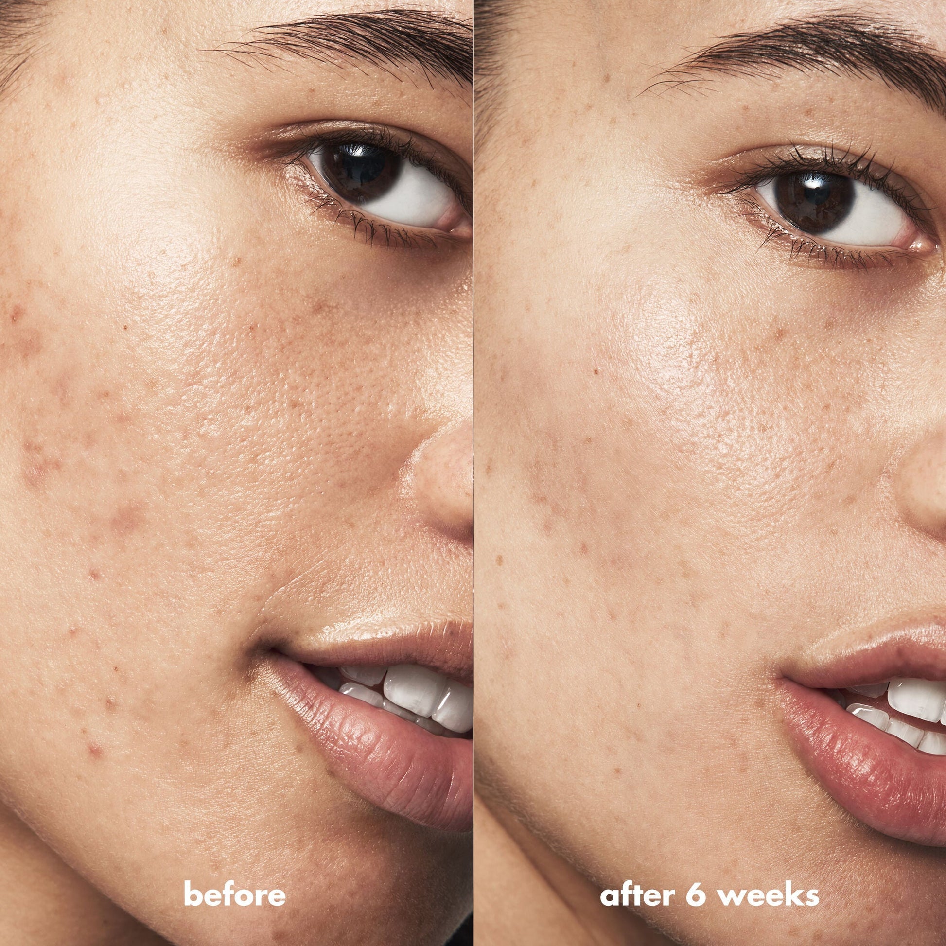 blemish-breakthrough-blemish-control-basics-kit-k6 Acne_PDP_Isabella_Before_After_0fcb9356-ae60-4e94-8953-6b1b2219dc49.jpg