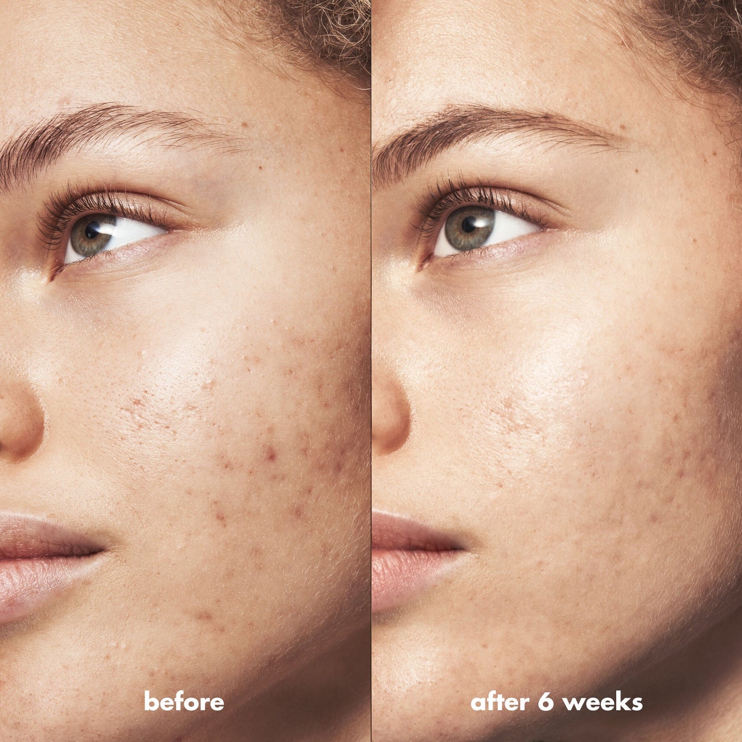 blemish-breakthrough-acne-clarifying-cleanser-o3 Acne_PDP_Marley_Before_After_216490cc-567c-424e-91eb-5374368f15d6.jpg